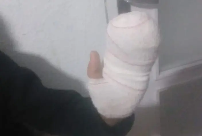 Imagen de la mano de Aar&oacute;n que sufri&oacute; quemaduras y fue atendido en el Hospital Miguel Servet /H.A.