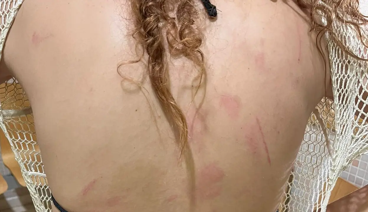 Parte de las lesiones que denunciaron y fotografiaron dos hermanas en el Festival 'Reguet&oacute;n Beach' en Zaragoza/ Cedidas a H.A.