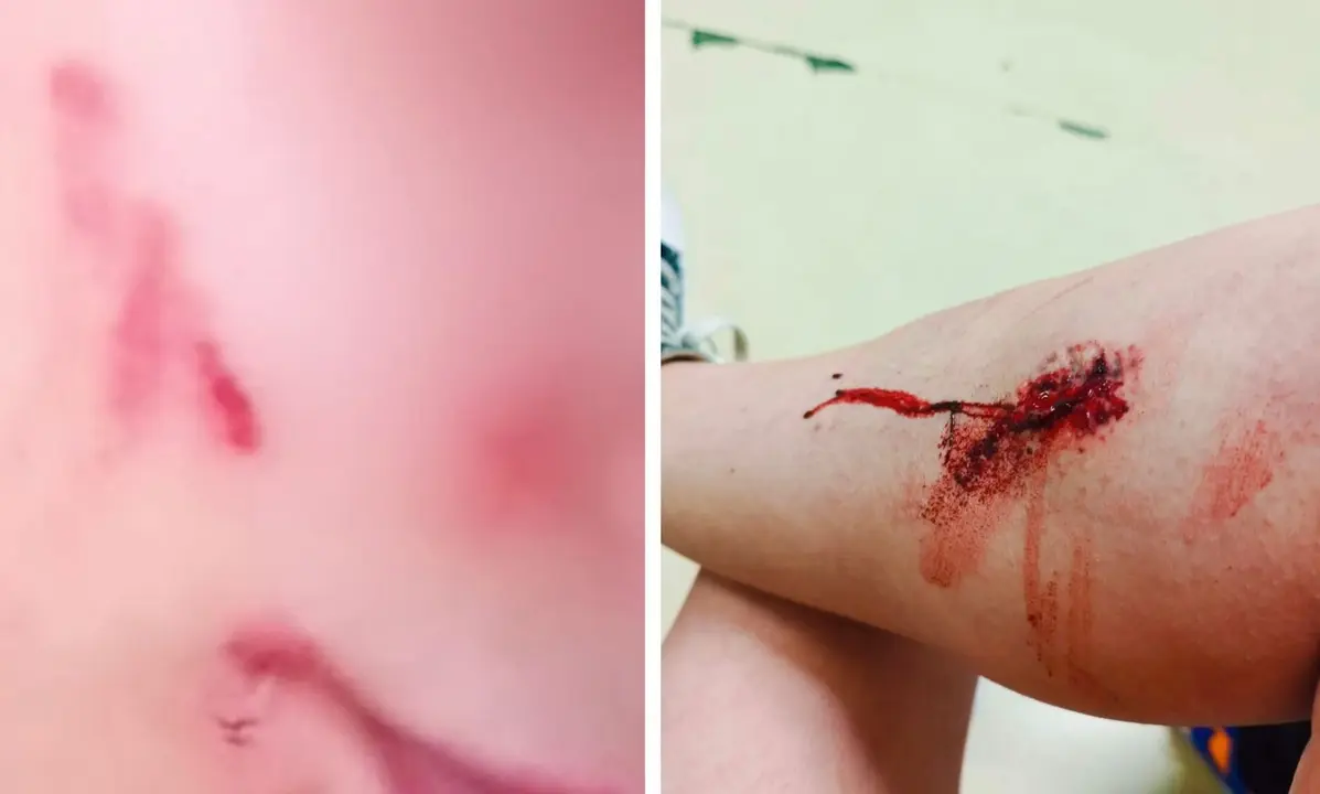 Algunas de las heridas que se produjeron tras la agresi&oacute;n a una joven por parte de su ex pareja/ Cedidas a H.A.