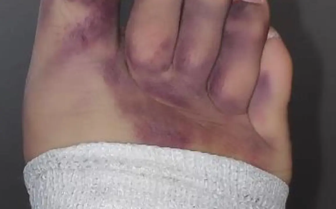 Imagen del pie de la denunciante tras sufrir una lesi&oacute;n que asegura le curaron mal/Cedida a H.A.
