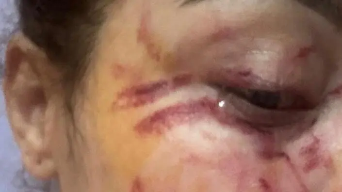 Imagen del rostro de la denunciante cuando fue al hospital a curar sus heridas/Cedida a H.A.