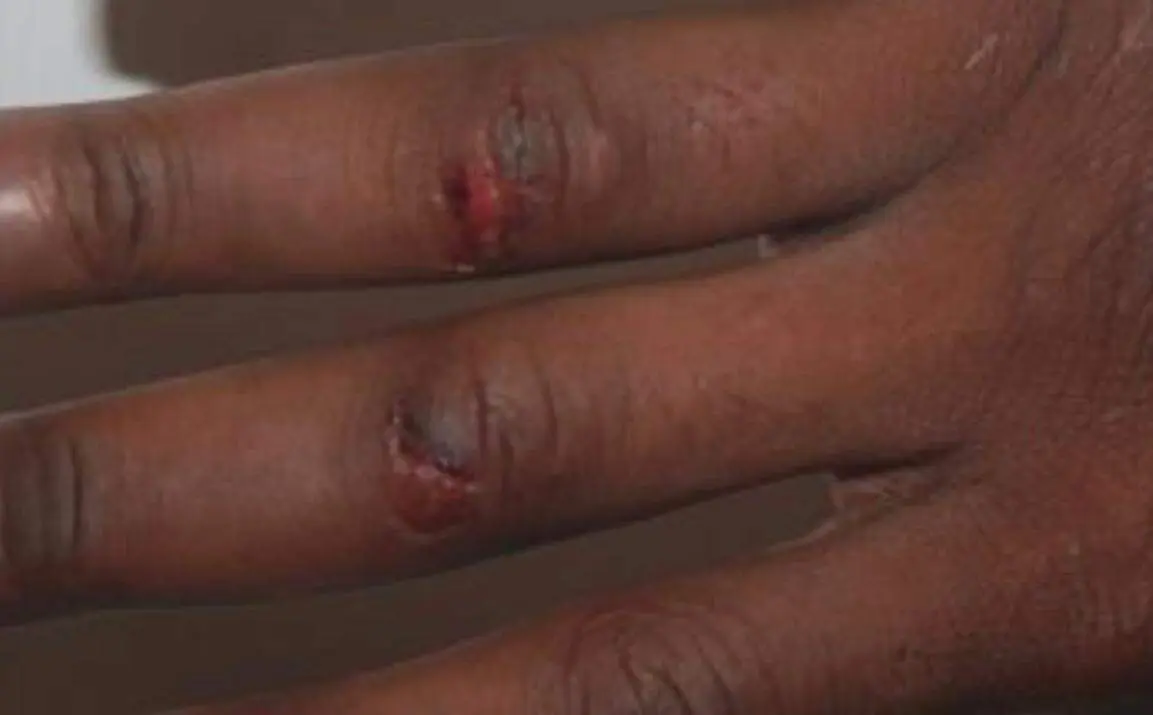 Imagen de la mano del detenido con heridas en sus nudillos/ Cedida a H.A.