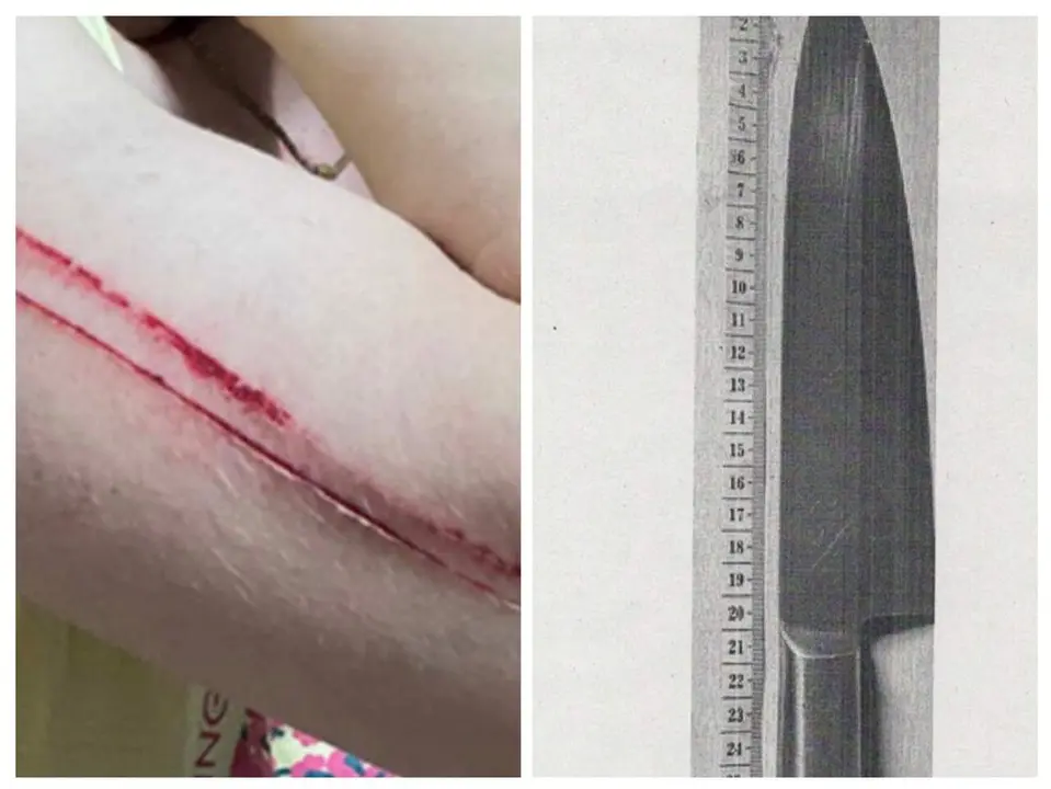 Imagen de alguna de las heridas de la v&iacute;ctima y el cuchillo con el que presuntamente le amenaz&oacute;/ 
Cedidas a H.A.