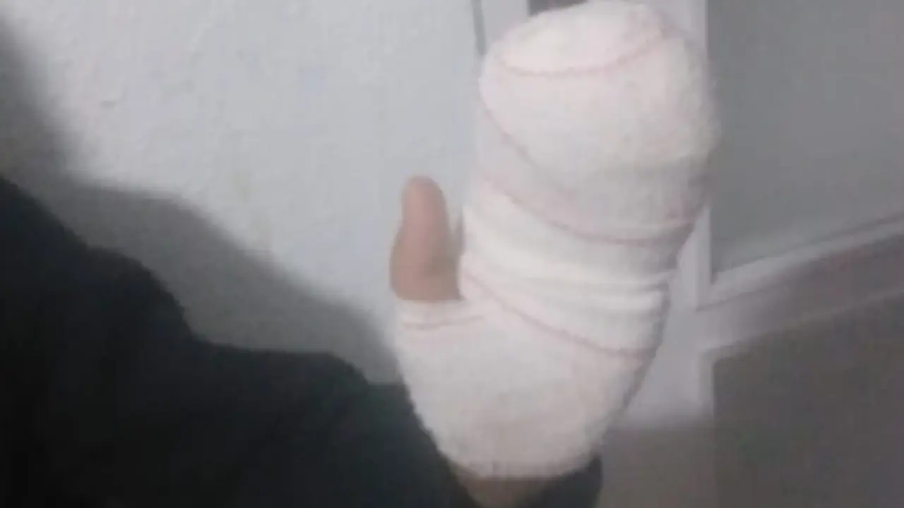 Imagen de la mano de Aar&oacute;n que sufri&oacute; quemaduras y fue atendido en el Hospital Miguel Servet /H.A.