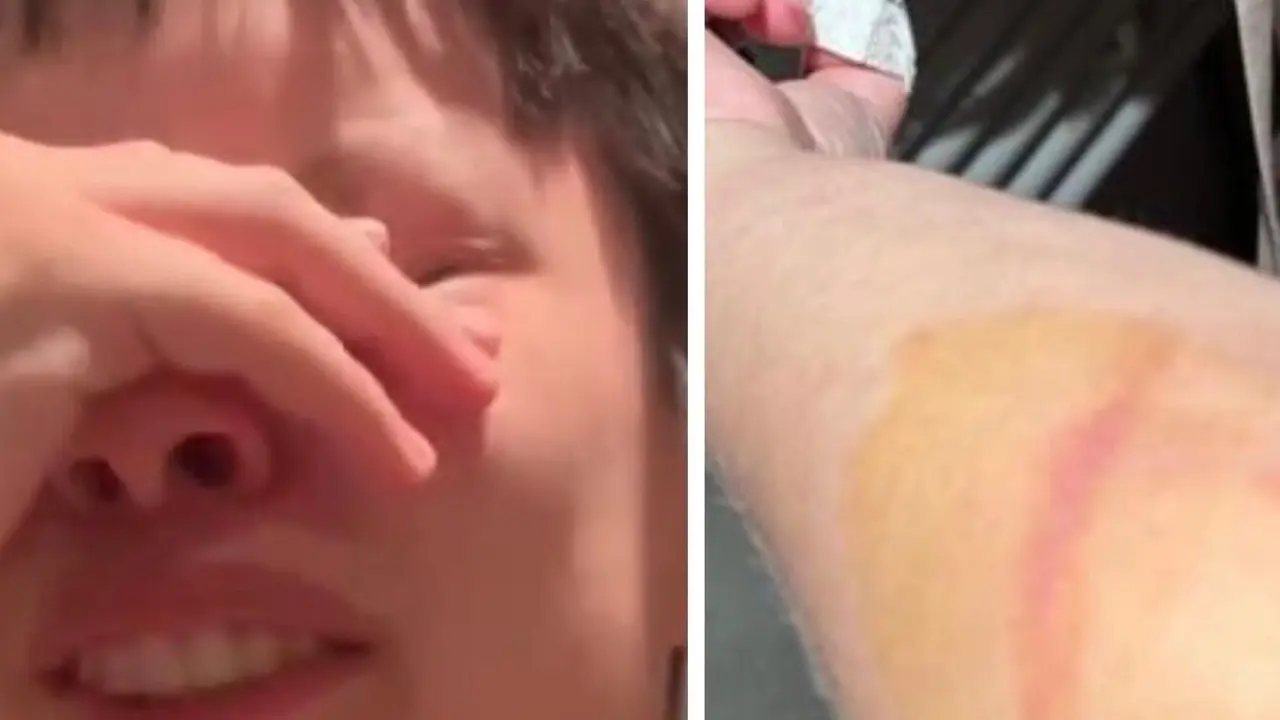 Imagen de las heridas y de la frustraci&oacute;n de esta v&iacute;ctima del ataque/ Cedidas a H.A.