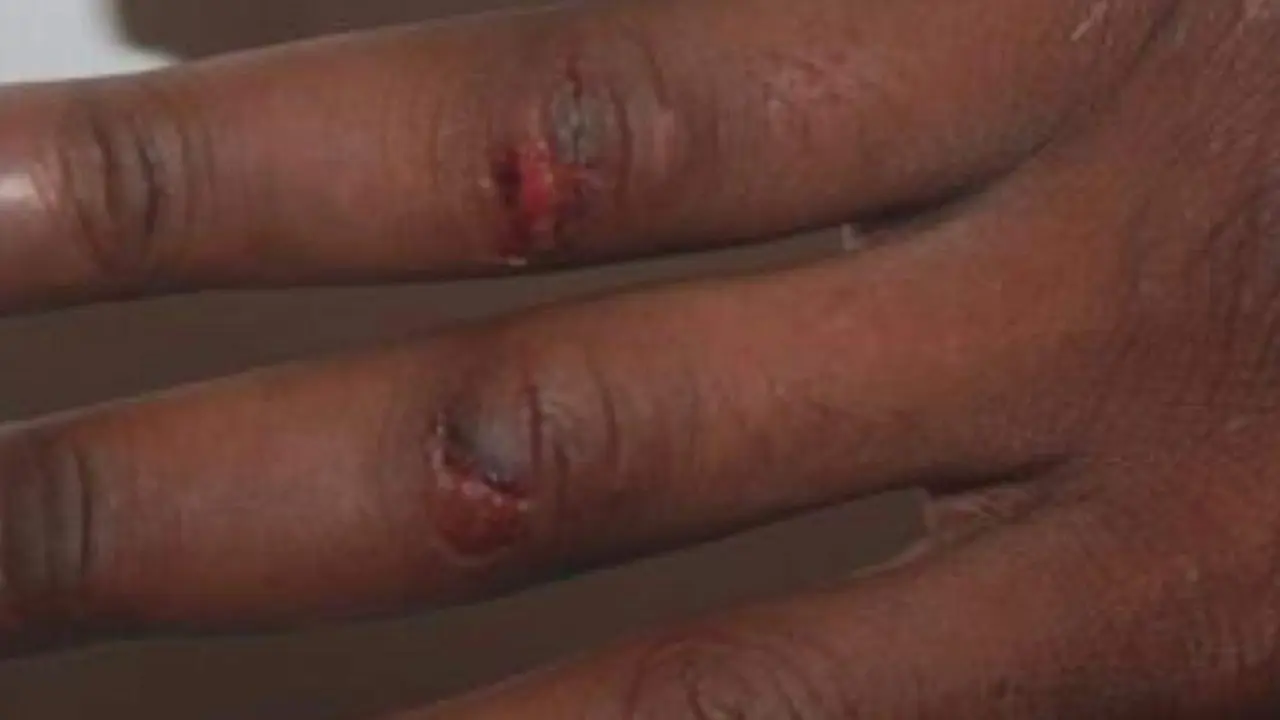 Imagen de la mano del detenido con heridas en sus nudillos/ Cedida a H.A.
