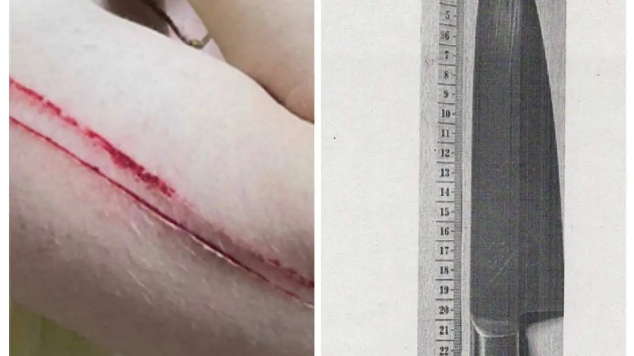 Imagen de alguna de las heridas de la v&iacute;ctima y el cuchillo con el que presuntamente le amenaz&oacute;/ 
Cedidas a H.A.