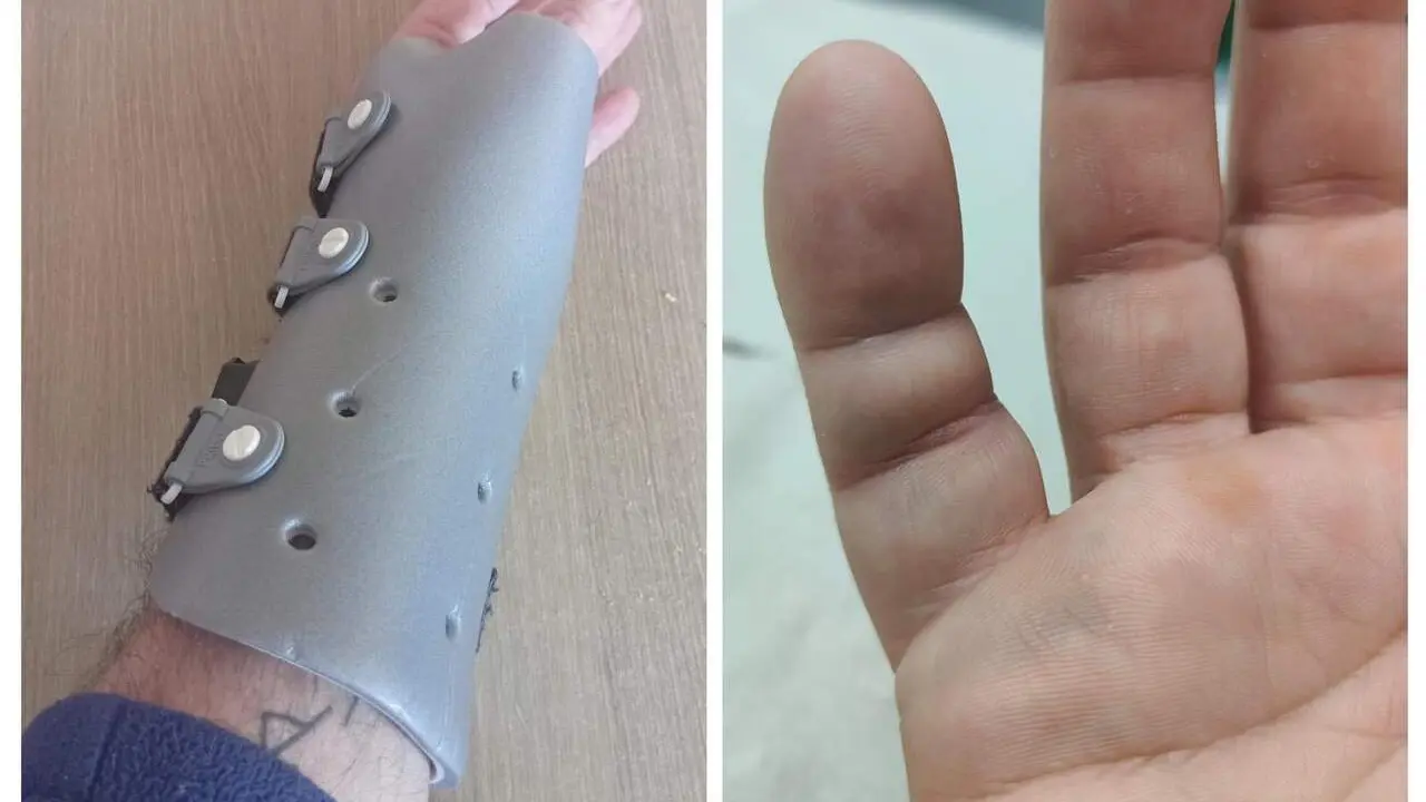 Im&aacute;genes de lesiones de vigilantes de seguridad en el ejercicio de sus funciones en Zaragoza/ Cedidas a H.A.