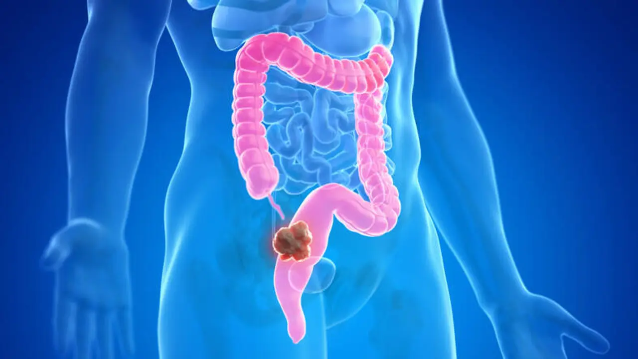 Ilustraci&oacute;n de c&aacute;ncer de colon. / Asociaci&oacute;n espa&ntilde;ola contra el c&aacute;ncer