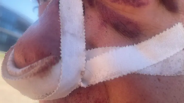 Imagen de las heridas del rostro del polic&iacute;a nacional agredido /H.A.