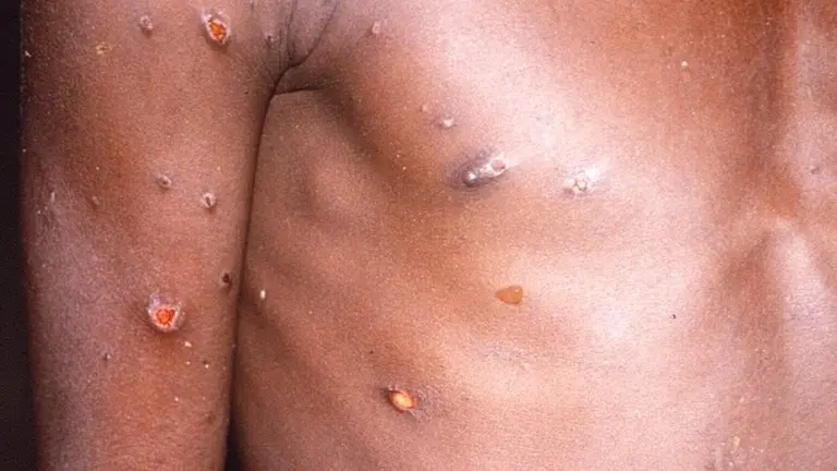 La viruela del mono produce lesiones cut&aacute;neas, fiebre y dolor corporal en las personas afectadas por el virus / CDC 