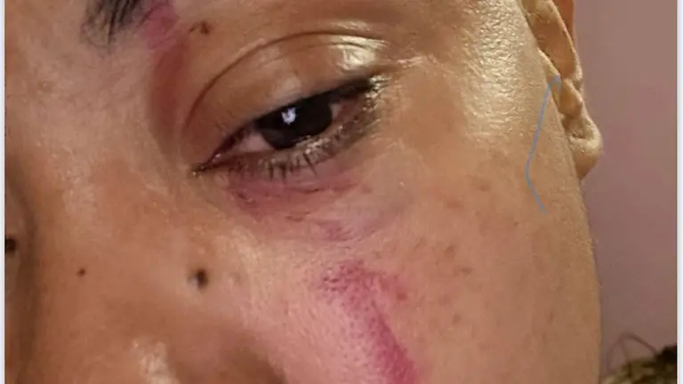 Imagen de las heridas en la cara de una de las v&iacute;ctimas /Cedida a H.A.