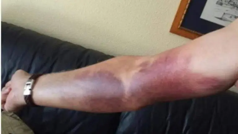 Imagen de una de las heridas de un funcionario en otra intervenci&oacute;n/ Cedida a H.A.