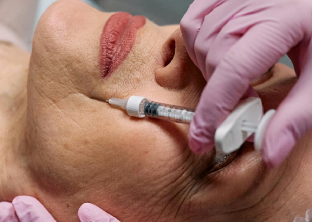 botox2